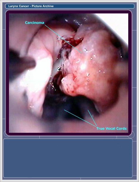 Slide 15.  T2 Supraglottic SCC