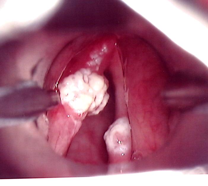 Two T1 Cancers of the True Vocal Cords - Larynx