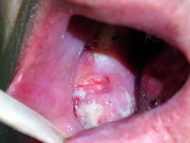 http://www.tobacco-facts.info/images/20050817-oral-cancer-3.jpg