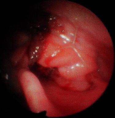 larynx with a Supraglottic and Glottic Carcinoma