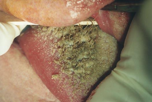 http://www.tobacco-facts.info/images/hairy_tongue.jpg