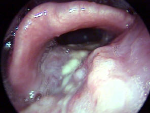 Large Cancer of the Hypopharyxn Causing Airway Obstruction